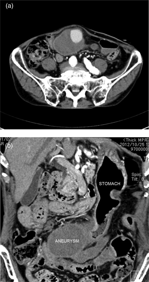 Computed tomography of the abdomen showed a huge arterial aneurysm in the right gastroepiploic artery.