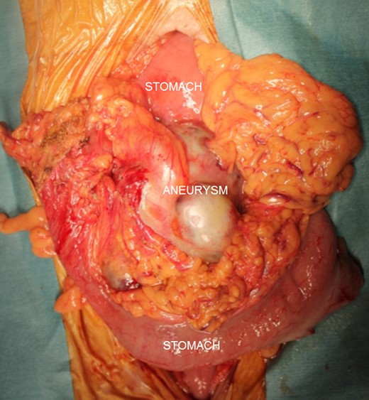 The aneurysm was easily identified in the greater curvature of the stomach and was found to adhere firmly to the transverse colon.
