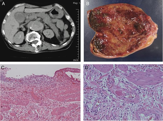 (A) CT showed Stanford type B aortic dissection, gallbladder wall thickness without gallstones and swollen pancreas. (B) Macroscopic examination showed the necrosis of the gallbladder fundus. (C) Histological examination revealed that partial mucosal defect, mucosal/submucosal arterial thrombi and submucosal bleeding in the body of the gallbladder wall (H&E ×100). (D) Histological examination revealed the fresh thrombi formation in the arterioles at the fundus of the gallbladder (H&E ×400).