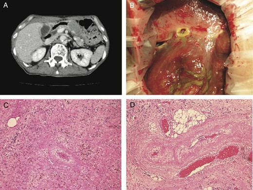 (A) CT showed Stanford type B aortic dissection, the wall defect of gallbladder fundus and the local fluid collection. (B) Laparotomy showed the perforation of the gallbladder fundus. (C) Histological examination showed fibrosis and hemosiderosis in the subserosal layer (H&E ×100). (D) Fibrotic change of arterioles was dominant at the peripheral part of the gallbladder (H&E ×100).