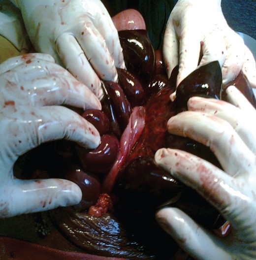 Intraoperative pictures showing loop of the small intestine making a knot on the distal ileal segment resulting in gangrene of most of the loops.