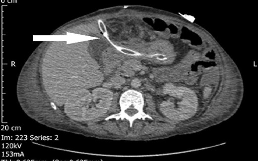 Transgastric drain (marked by arrow).