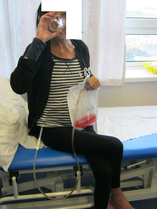 Patient drinking blackcurrant cordial in clinic with passage into her transgastric drain.