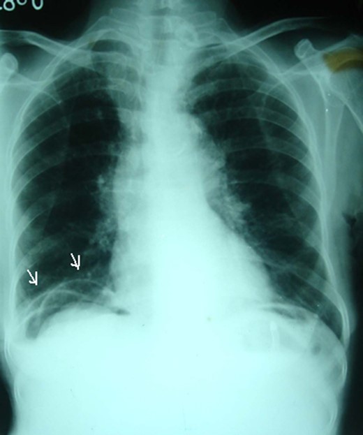 A plain erect chest radiograph showing appearance of radiolucency under the right hemidiaphragm (arrows).