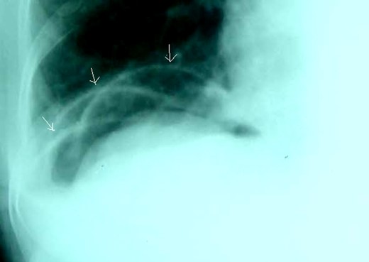 Careful examination showing semilunar opaque lines which were walls of small bowel loops (arrows).
