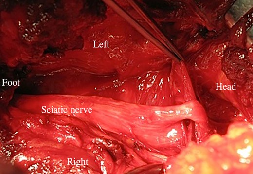 The forceps shows the muscle slip.
