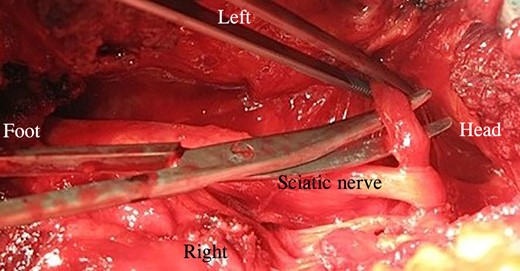Surgical scissor shows how stretching the muscle bundle affected sciatic nerve.