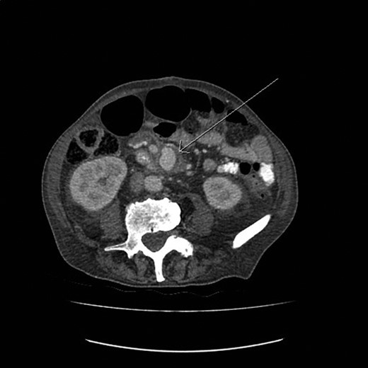 The CT image demonstrating a SMAA measuring 4.4 × 3 cm in size.