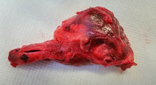 The excised SMAA.