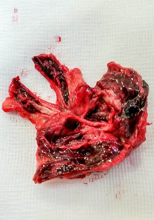 The cross section of the excised SMAA.