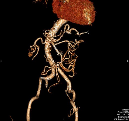 The postoperative CT image (3D reconstruction) demonstrating complete resection of the aneurysm.