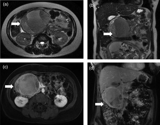 Magnetic resonance images reveal a well-circumscribed solid and cystic mass in the region of the pancreas head. Antepartum, non-contrast images in axial (a) and coronal (b) views. Postpartum, contrast-enhanced images in axial (c) and coronal (d) views.