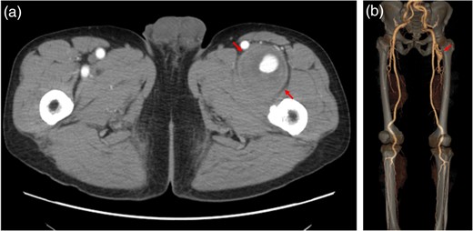 Multidetector computed tomography revealed a large DFA aneurysm (arrows show aneurysm).