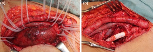 (a) The common femoral artery, superficial femoral artery, superficial femoral vein and deep femoral vein were recognized and preserved. (b) Aneurysmectomy and revascularization of the distal DFA with an artificial blood vessel graft were performed.