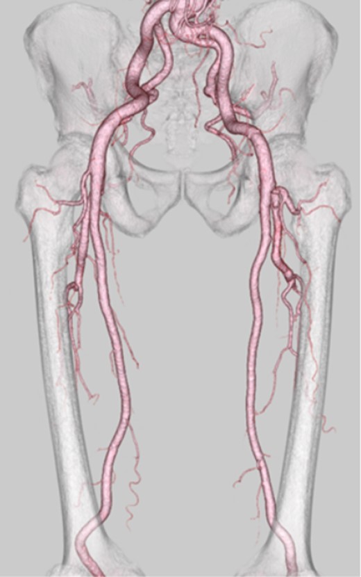 A follow-up multidetector computed tomography scan showed good blood flow in the graft, superficial femoral artery and popliteal artery.