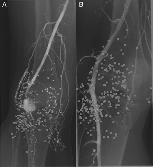 A digital subtraction angiogram of the right popliteal artery demonstrating the pseudoaneurysm, pre- (A) and post- (B) stenting. Note the numerous pellets in the soft tissues.