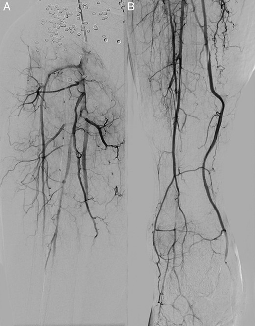 A digital subtraction angiogram at presentation (A) and after 48 h of continuous alteplase thrombolysis (B) demonstrating the improved patency of the infrapopliteal arteries.