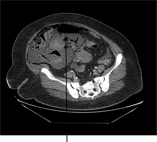 CT abdomen showing large air-filled right abdominal mass that appears to be a septic ovarian cyst.