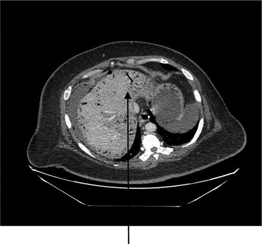 CT abdomen showing diffuse portal venous gas in the liver.