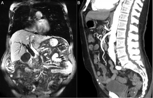 (A) MRI of the abdomen demonstrated marked intrahepatic biliary dilatation due to an abrupt high-grade stricture of the distal CBD at the level of the pancreatic head. (B) CT angiography of the abdomen showed patent celiac artery despite moderate narrowing at the origin of the celiac artery.