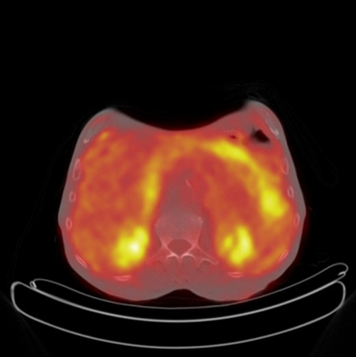 Axial PET CT showing increased FDG uptake in the mesentery of the left upper quadrant suspicious for metastatic recurrence.