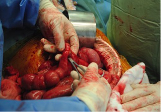 Intra-operative identification of the entero-enteric fistula.