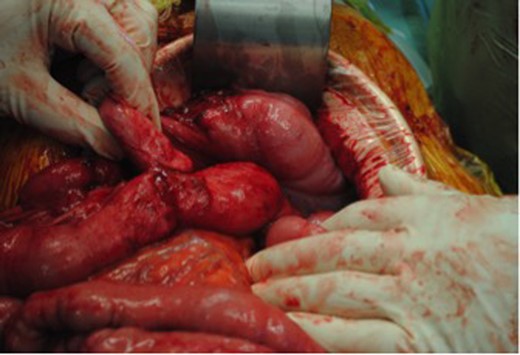 Jejunal-ileal fistula originating from the stump of the previous end-to-side ileocolic anastomosis.