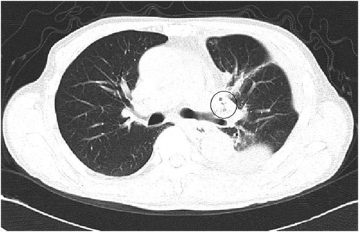 A CT image at the second admission. A few small bubbles could be seen in the pleural space adjacent to the left upper bronchial stump. No major thoracic air space was observed.