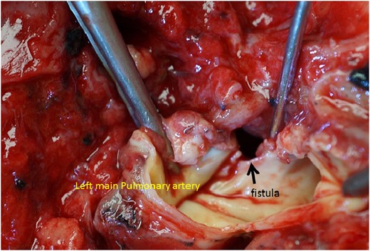 The autopsy revealed a huge fistula between the left main pulmonary artery and the upper lobe bronchial stump. The surrounding tissues have become extremely stiff, which suggests prior prolonged inflammation.