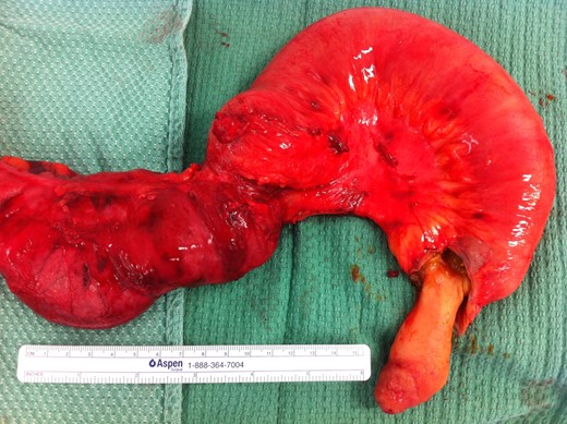 The inverted MD after being everted.