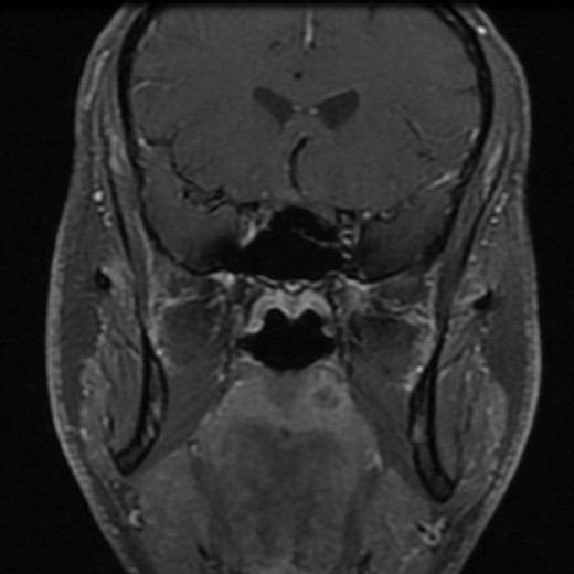 Post-gadolinium T1-weighted coronal section showing the lesion on the palate.
