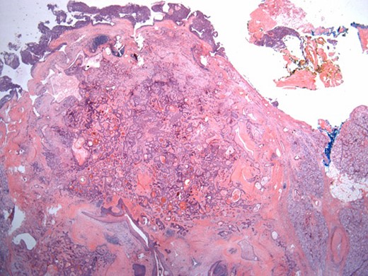 Well-circumscribed tumor on low power view. Hematoxylin and eosin (H&E ×25).