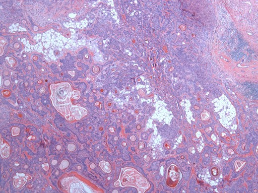 Solid sheets and massive squamous metaplasia with keratinization. Presence of adipose stroma. Hematoxylin and eosin (H&E ×40).