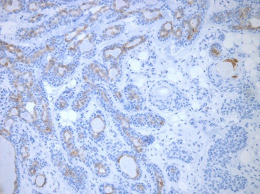 Luminal epithelial cells lining tubular structures highlighted by immunohistochemistry. EMA (×250).
