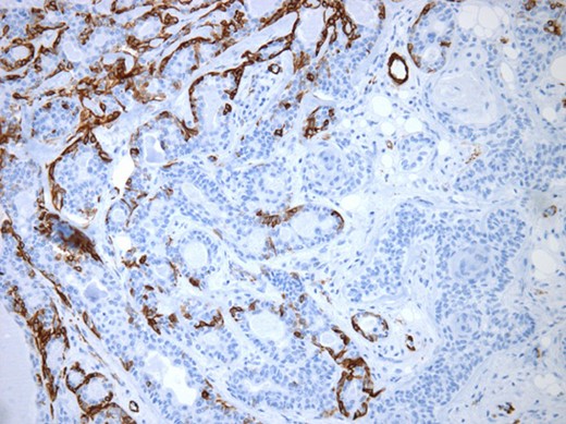 Myoepithelial cells highlighted by immunohistochemistry. SMA (×250).