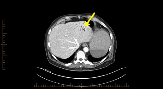 Computerized tomography abdominal axial section showing air within the hepatic portal veins (yellow arrows).