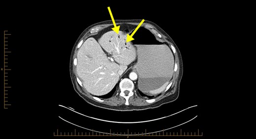 Computerized tomography abdominal axial section showing air within the hepatic portal veins (yellow arrows).