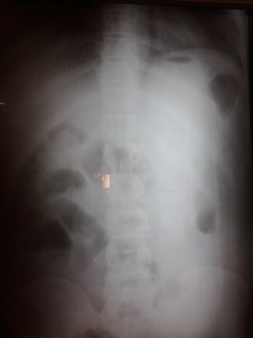 Plain abdominal radiography showing air-fluid levels.