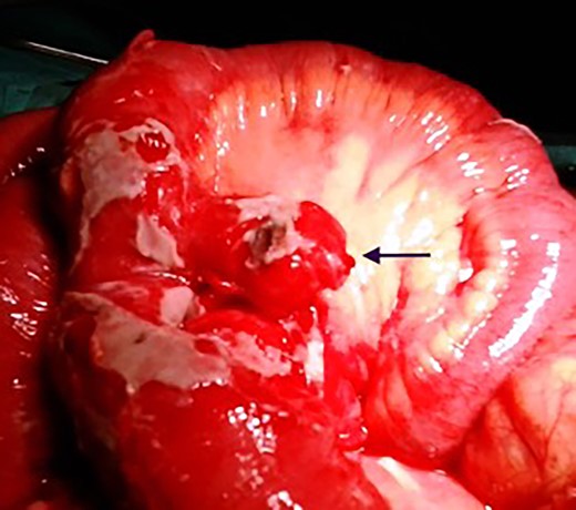 Intraoperative findings of perforated mesenteric Meckel diverticulum.