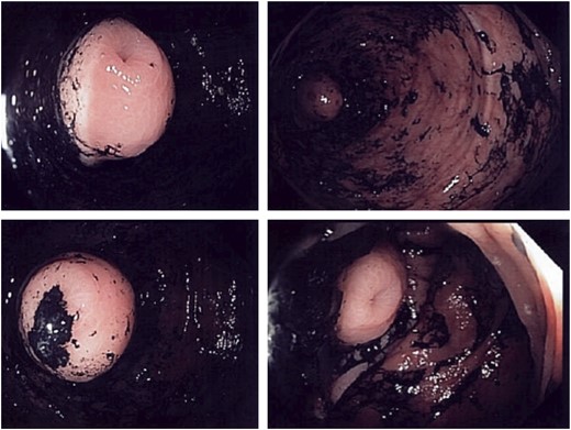 Colonoscopy views of the caecum.