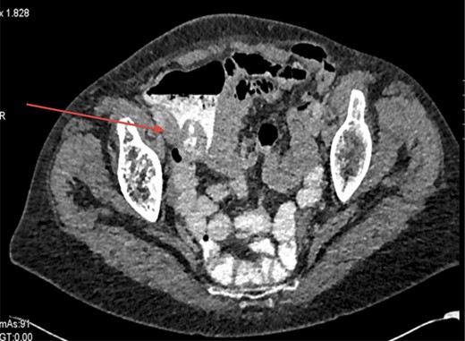 CT scan showing the caecal mass near to the ileocaecal valve.