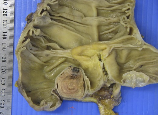 A macroscopic view of the resected specimen.