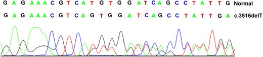 Normal and mutant sequences of the APC gene mutation in codon 1172.