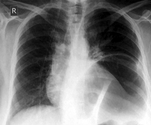 Chest x-ray showing an elevated air-fluid left in the left basal lung region.
