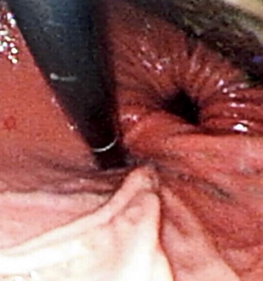 Flexible upper endoscopy showing herniation of the distal stomach, the pylorus and the first part of the duodenum into the left hemi-thorax.