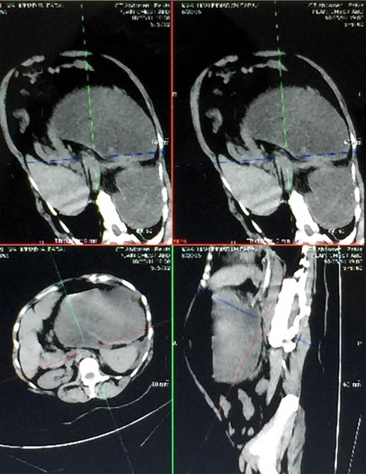 Different views of a double contrast-enhanced CT scan showing a left diaphragmatic hernia with an acute dilated stomach.