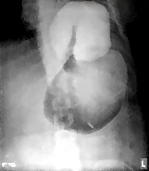 Water-soluble gastrografin meal showing an intra-thoracic mesentero-axial volvulus.