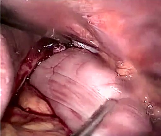 Laparoscopic view showing the incarcerated content in the peritoneal sac with a twisted stomach.
