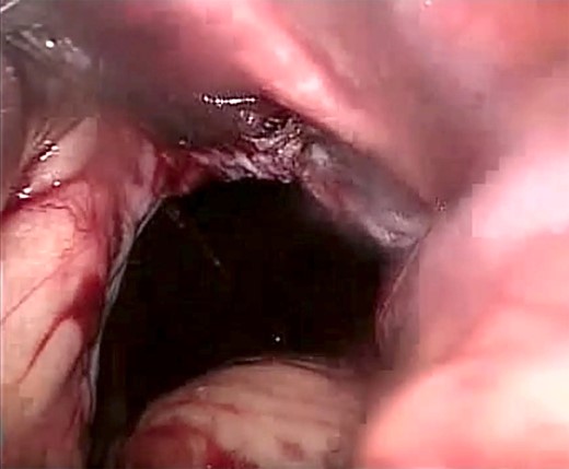 Laparoscopic view showing a large (size 7 × 7 cm) diaphragmatic defect.