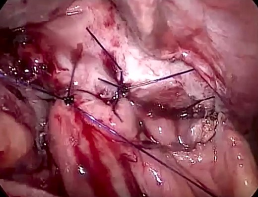 Laparoscopic view showing the primary closure of the diaphragmatic defect using an interrupted PDS™ II Suture.